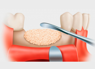 Oseointegración en implantes dentales