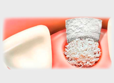 Reconstrucción ósea para implantes dentales