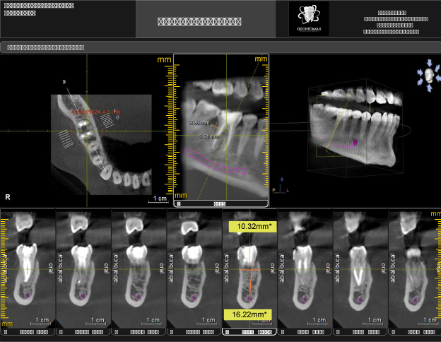 endodoncia