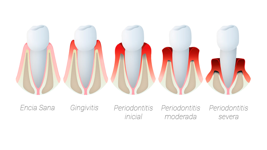 periodoncia-tratamiento-encias