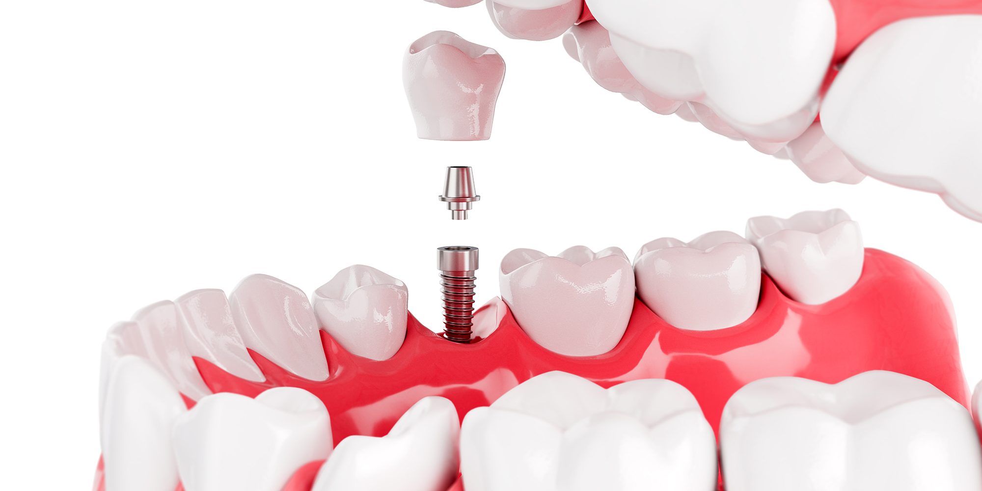 ¿Qué Son Los Implantes Dentales? - Red Implantologia Viña