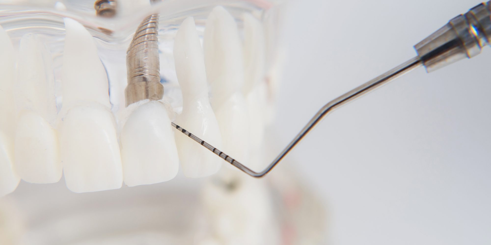 Close up Process Implants teeth health care on white background.