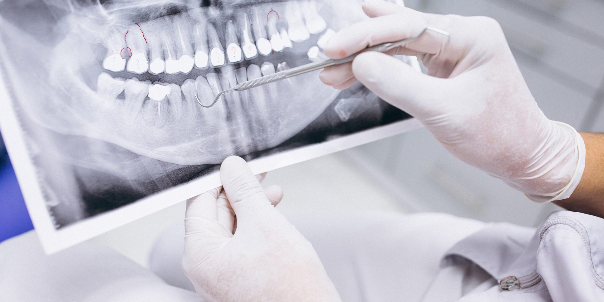 Close up Process Implants teeth health care on white background.