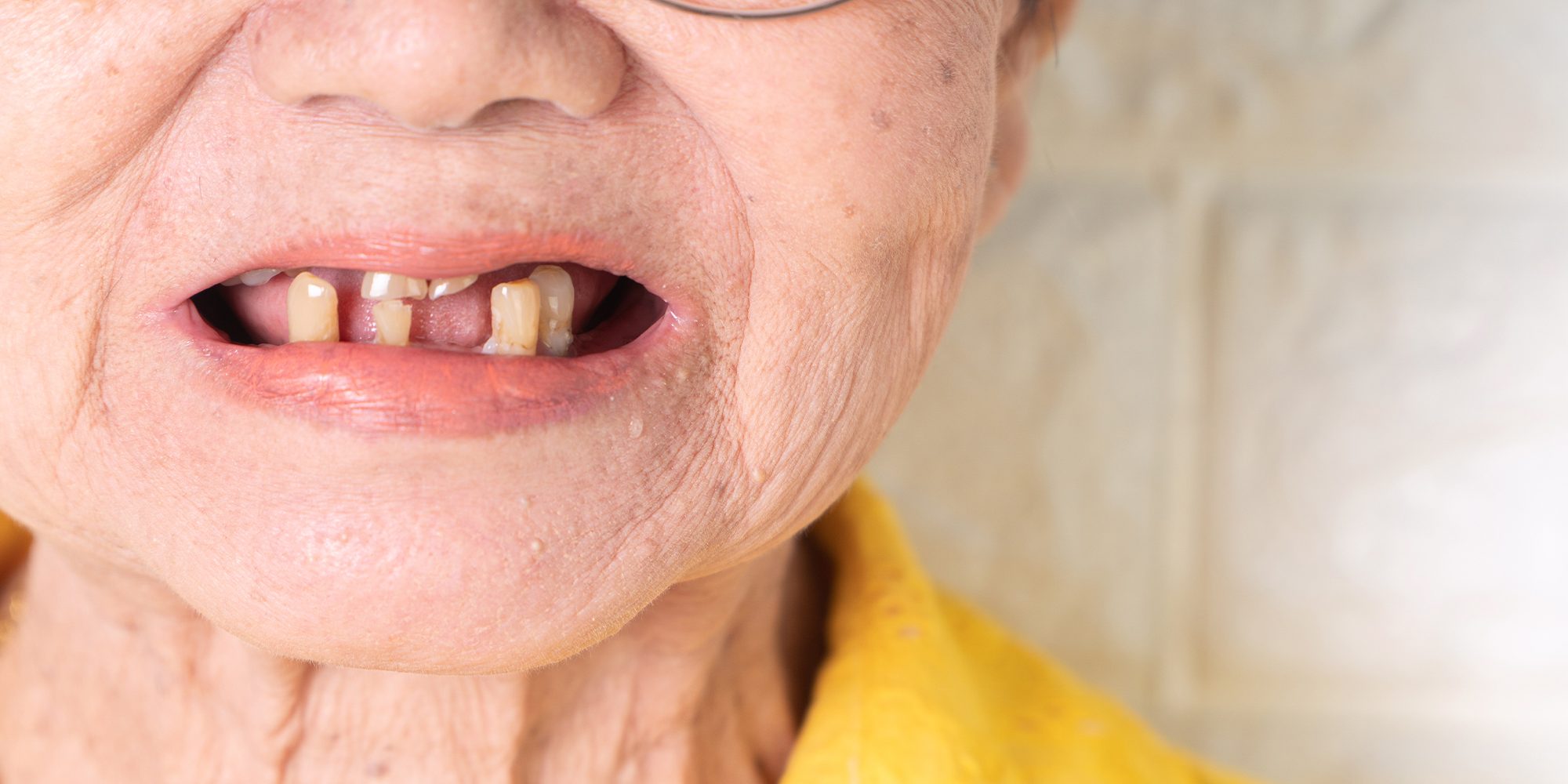 Close up Process Implants teeth health care on white background.
