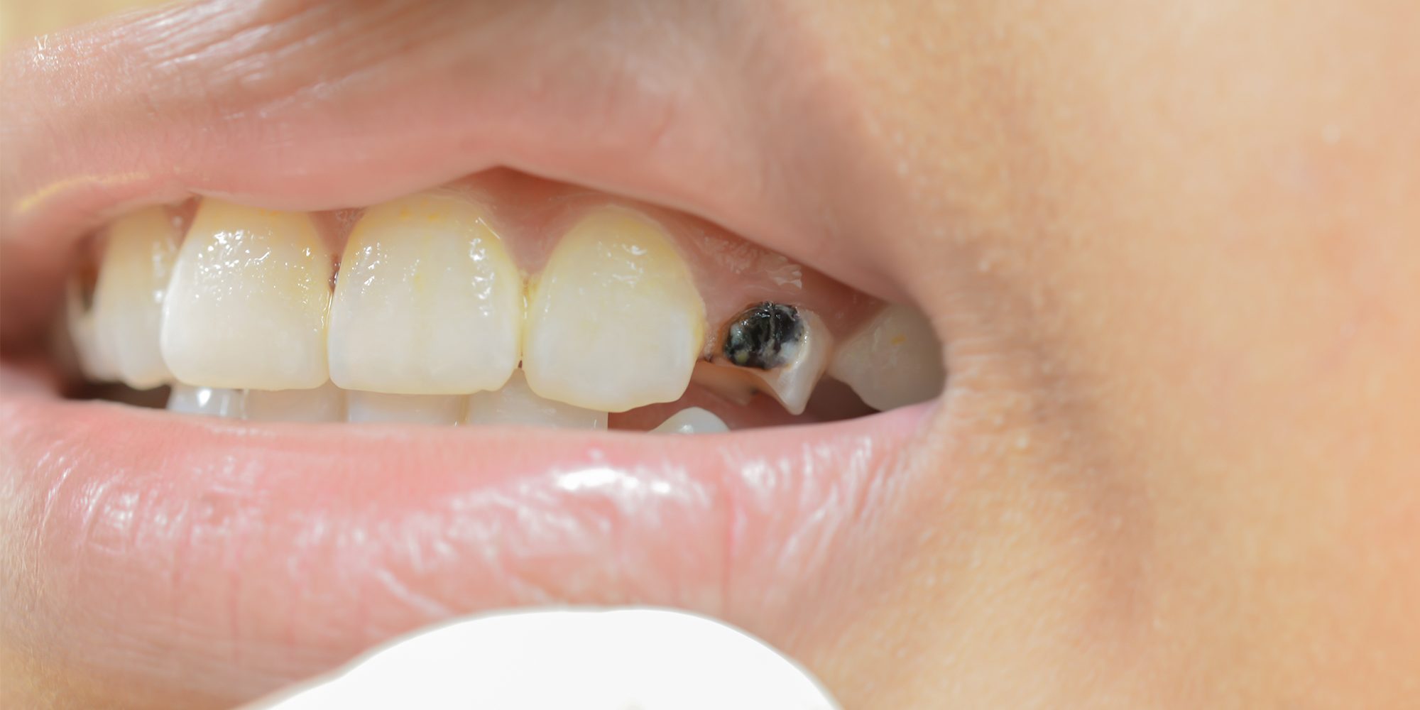 Close up Process Implants teeth health care on white background.