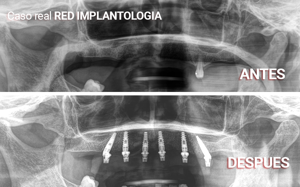 caso-real-red-implantologia