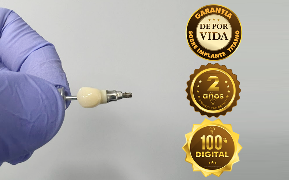 implante-dental-corona