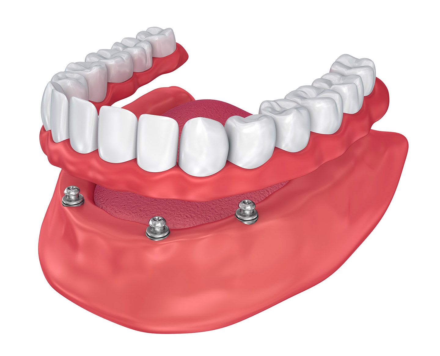 protesis-fija-sobre-implantes