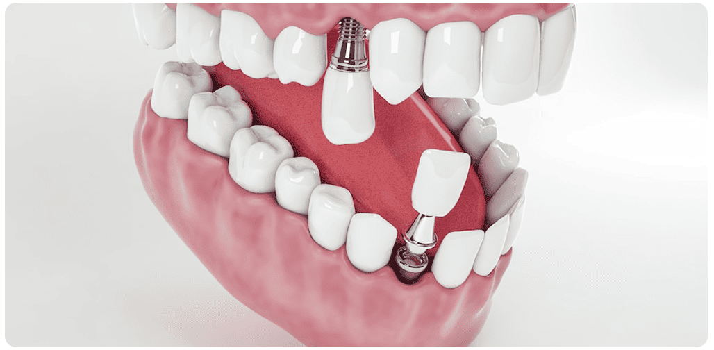 Implantes dentales de avanzada