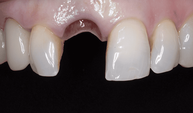 Implante dental sobre corona de Zirconio