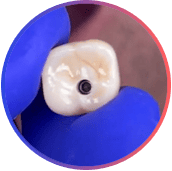 Corona dental de implante dental