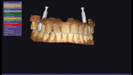 Laboratorio digital en implante dental