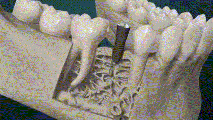 cirugía en implante dental