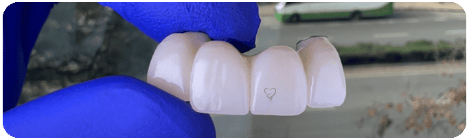 Precio de implante dental en Chile