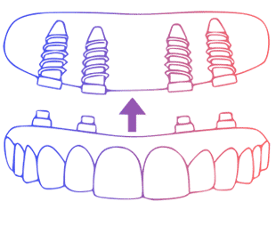 Implantes dentales de arcos completos