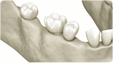 Recuperación rápida en implantes dentales